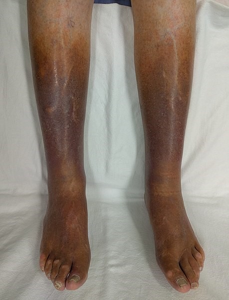 Chronic Venous Insufficiency