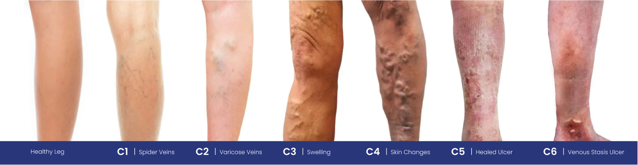 Chronic Venous Insufficiency - Lymphatic Therapy Services