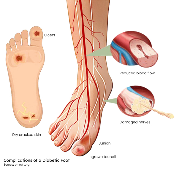 Should You Worry About a Diabetic Foot Ulcer? + Prevention and Treatment  Options - South Shore Foot & Ankle