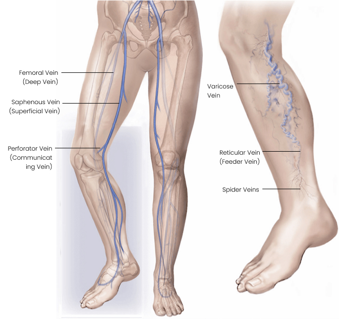 Varicose and Spider Veins - Cape Town Vascular