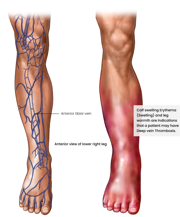 blood clot in upper leg